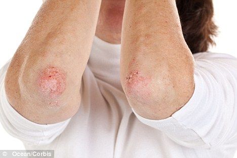 The impact a skin disorder such as psoriasis can have on mental health is too often underestimated by GPs and non-sufferers. Bed Sores, Skin Disorders, Skin Diseases, Itchy Skin, Homeopathy, Natural Treatments, Health Remedies, Pain Relief, Home Remedies