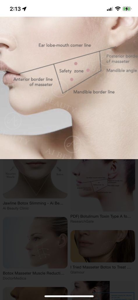 Botox Anatomy, Botox Mapping, Aesthetic Nurse Injector, Face Injections, Botox Injection Sites, Facial Injections, Botox Face, Facial Anatomy, Cosmetic Injectables