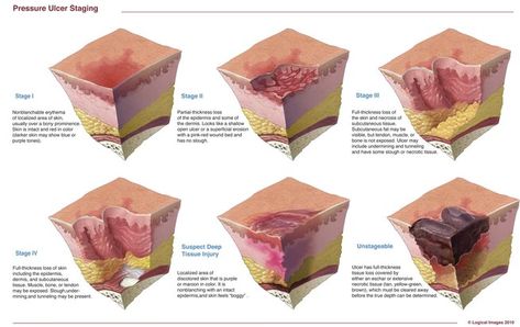 FAQs for pressure ulcer staging | Wound Care Advisor Braden Scale Mnemonic, Braden Scale Nursing, Braden Scale, Pressure Ulcer Staging, Medical Assistant School, Wound Management, Wound Care Nursing, Nurse Teaching, Medical Esthetician