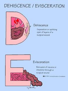 dehiscence evisceration #nursing #nclex #dehiscence-evisceration dehiscence evisceration #nursing #nclex #dehiscence-evisceration Wound Care Nursing, Nursing School Life, Nursing Information, Nursing Assessment, Nursing Mnemonics, Nursing Student Tips, Surgical Nursing, Medical Surgical Nursing, Nursing School Survival