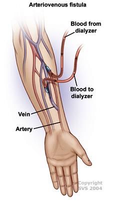 Body Knowledge, Vascular Ultrasound, Kidney Donor, Vascular Surgery, Picu Nurse, Arteries And Veins, Kidney Friendly, Emergency Nursing, Eating Plan