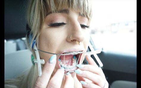 Headgear Braces, Braces Girl, Orthopedic Brace, Adult Braces, Braces Girls, Orthodontic Appliances, Brace Face, Orthodontics Braces, Perfect Teeth