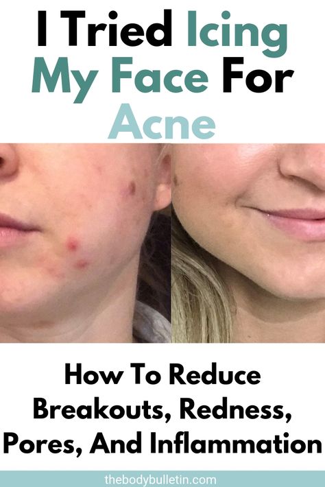 Does ice on acne help? Icing your face benefits include reducing redness, inflammation, and breakouts. Here's what you can expect if you ice your face for acne. Acne Inflammation Remedies, Face Redness Remedy Diy, Does Ice Help Pimples, Is Ice Good For Your Face, Ice For Acne, Reduce Redness In Face Acne, Breakouts On Face Remedies, Face Inflammation Remedies, What Does Icing Your Face Do