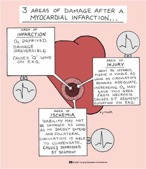 Ischemia, injury and infarction on a EKG Ccrn Prep, Nursing Tools, Nursing Knowledge, Nursing Essentials, Nursing Gifts, Nursing Information, Nursing Mnemonics, Nurse Student, Surgical Nursing