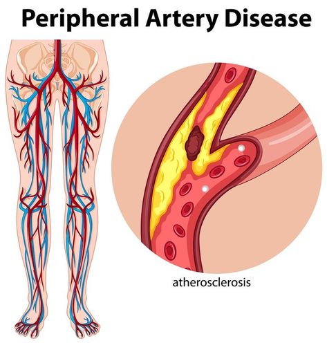 What is Peripheral Arterial Disease, peripheral vascular disease Peripheral Artery, Leg Ulcers, Vascular Surgery, Venous Insufficiency, Arteries And Veins, Disease Symptoms, Lower Limb, Heart Problems, Wound Care