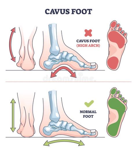 Cavus foot with abnormal high arch condition to feet bones outline diagram stock photo Diagram Illustration, Fallen Arches, Sport Photoshoot, Flat Foot, Teaching Biology, Thai Massage, Foot Massage, Foot Care, Human Anatomy