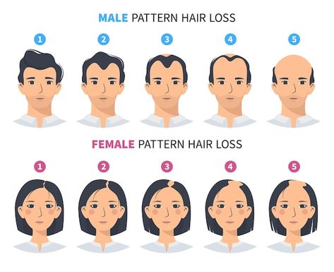 Hair loss stages androgenetic alopecia m... | Premium Vector #Freepik #vector #hair-growth #hair-loss #scalp #hair-problem Male Hairline, Micro Pigmentation, Androgenic Alopecia, Losing Hair, Hair Transplant Results, Androgenetic Alopecia, Smart Casual Work Outfit, Smart Casual Work, Health Guru