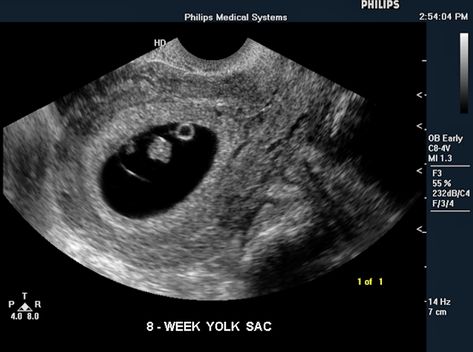 2 Month Ultrasound Picture, Fetal Ultrasound, Pregnancy Scan, Ultra Sound, 7 Week Ultrasound, Fake Ultrasound, 4d Ultrasound, Pregnancy Ultrasound, Mri Scan