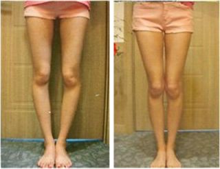 Leg Transformation, Genu Varum, Legs Care, Bow Legged Correction, Knock Knees, Bow Legged, Body Firming, Knee Exercises, Body Posture