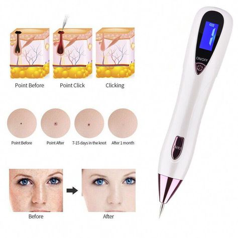 Find many great new & used options and get the best deals for Laser Plasma Skin Tag Freckle Wart Dot Mole Remove Pen Dark Spots Tattoo Removal at the best online prices at eBay! Free shipping for many products! Spot Tattoo, Mole Tattoo, Tattooed Freckles, Blackhead Remover Diy, Remove Skin Tags Naturally, Plasma Pen, Eyelid Lift, Skin Moles, Get Rid Of Warts