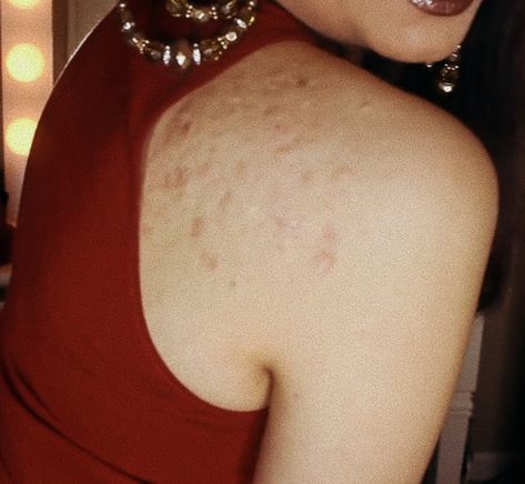 Real Skin Aesthetic, Back Acne Aesthetic, Body Acne Positivity, Romanticizing Acne, Imperfect Bodies, Acne Aesthetic, Acne Positivity, People With Acne, Back Acne