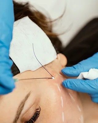 The use of PDO threads for midface lifting is simpler, faster and less invasive than conventional surgical methods, while providing satisfactory results for at least 6-8 months.
#pdothreadlift #threadlift #threadlifting
#threadlifts #cogthread #barbedthreads #trådlyft #fadenlifting #fadenlift #cogthreadlift Face Threading, Pdo Threads, Thread Lift, 8 Months, Thread, Quick Saves