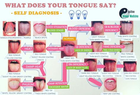 Tcm Tongue Diagnosis, Tongue Chinese Medicine, Ayurvedic Tongue Diagnosis Chart, Tongue Reading Health, Ayurveda Tongue Chart, Tongue Diagnosis Chart, Chinese Medicine Tongue Diagnosis, Tongue Health Chart, Body Reading