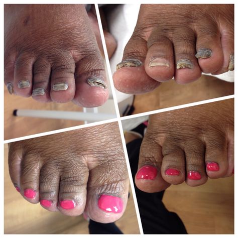 Keryflex toenail restoration. Instant results. Nail Reconstruction, Ugly Toenails, Amazon People, Beauty Room Salon, Nice Nails, Spa Inspiration, Pedicures, Beauty Room, Toe Nails