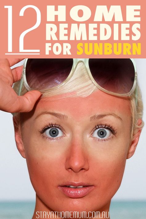 Sunburn Blisters, Blister Remedies, Sunburnt Face, Home Remedies For Sunburn, Get Rid Of Sunburn, Severe Sunburn, Bad Sunburn, Sunburn Remedies, Soothe Sunburn