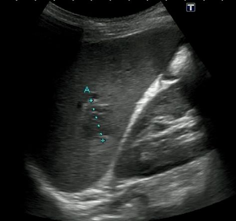 Abdominal Ultrasound, Medical Sonography, Anatomy Images, Diagnostic Medical Sonography, Inflammation Causes, Lymph Nodes, Stomach Pain, Internal Medicine, Radiology