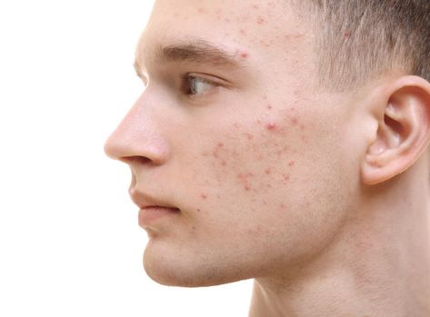 Male Acne, Acne Is Beautiful, Acne Aesthetic, Acne Men, Acne Positivity, Skin Positivity, Different Types Of Acne, Forehead Acne, Brain Logo