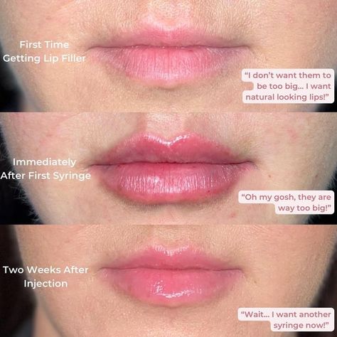 Lip Filler Swelling Day By Day, Lip Filler Healing Stages, Lip Aesthetic, Face Fillers, Skin And Makeup, Lip Enhancement, Lip Filler, The Healing Process, Lip Injections