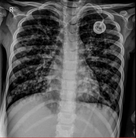 Difficulty breathing is the most serious symptom and results from frequent lung infections that are treated with antibiotics and other medications. Other symptoms—including sinus infections, poor growth, and infertility—affect other parts of the body Radiology Notes, Chest Xray, Paranasal Sinuses, Natural Decongestant, Dairy Free Breastfeeding, Lung Infection, Underarm Odor, Medical Student Study, Pulmonology