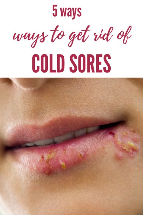 Get rid of cold sores over night Cold Sore Remedy Overnight How To Get Rid, Cold Sores Remedies Overnight, How To Get Rid Of Cold Sores, Coldsore Remedies Overnight, How To Get Rid Of Cold Sores Overnight, Quick Cold Sore Remedy, Home Remedy For Cold Sore On Lip, Cold Sore Remedy Overnight, Essential Oil For Cold Sore On Lip