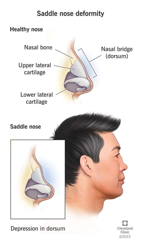 Pug Nose, Anatomy Tips, Rhinoplasty Nose Jobs, Nasal Septum, Nose Surgery, Injectables Fillers, Nose Shapes, Facial Plastic, Cleveland Clinic