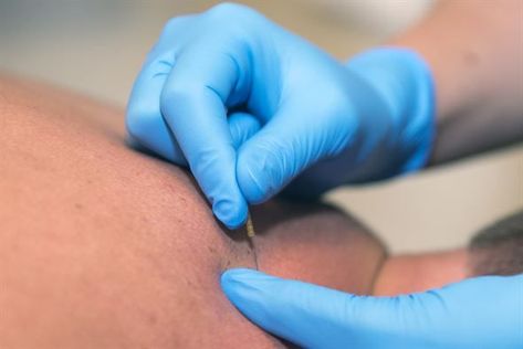 Research Studies Show Dry Needling Has No Long-Term Benefits Dry Needling Therapy, Supraspinatus Muscle, Signs Of Inflammation, Shoulder Impingement, Dry Needling, Chiropractic Adjustment, Frozen Shoulder, Trigger Point, Shoulder Injuries