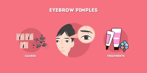 Eyebrow Pimples: Causes and Treatments | Skincare Hero Why Pimples Are Where They Are, Pimples Between Eyebrows, Eyebrow Acne, Acne Between Eyebrows, How To Prevent Pimples Skin Care, Why Am I Getting Pimples, How To Avoid Pimples, Pimple Causes, Small Pimples