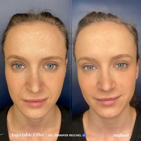 Laugh Lines Filler Before And After, Botox For Smile Lines, Smile Lines Filler Before And After, Smile Line Fillers Before And After, Restylane Before And After, Get Rid Of Laugh Lines, Eye Hollows, Lines Around Mouth, Under Eye Hollows