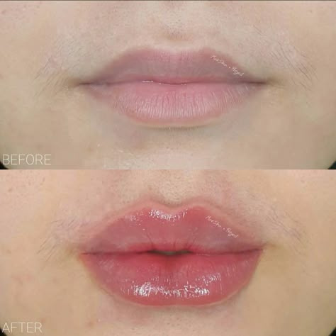 Lip Shapes For Fillers, Changing Lip Shape, Narrow Mouth Lip Filler, Light Lip Filler Before And After, Bottom Heavy Lip Filler, Lip Filler Bottom Lip Bigger, Lip Filler Inspiration Heart Shaped, Heart Lip Filler, Lip Filler Korea