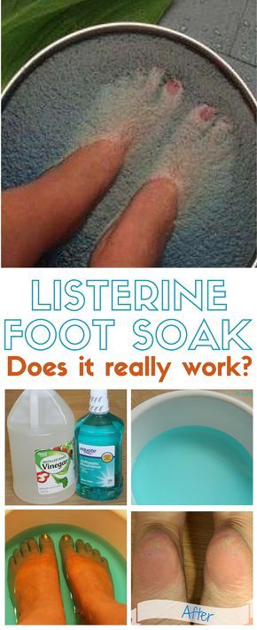 Pedicure Diy, Pedicure Soak, Listerine Foot Soak, Foot Soak Recipe, Diy Pedicure, Pedicure At Home, Foot Soak, Toenail Fungus, Lower Belly