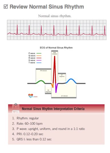 Review of Normal Sinus Rhythm Ekg Rhythms, Sinus Rhythm, Nursing Party, Ekg Interpretation, Normal Sinus Rhythm, Ecg Interpretation, Heart Project, Nursing 101, Nclex Prep