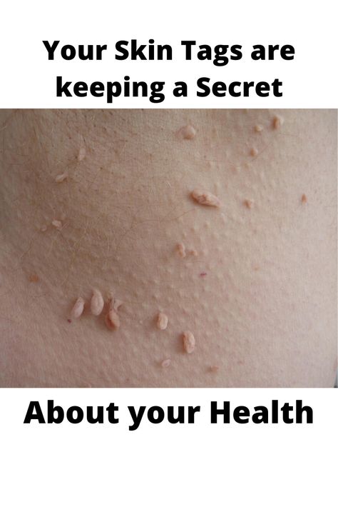 How To Get Rid Of Skin Tags, Skin Tags, How To Get Rid Of Skin Tags Naturally, Skin Tags Removal Overnight, Skin Tags What Causes, Best Way To Remove Skin Tags, Natural Ways To Remove Skin Tags, What Are Skin Tags, Causes Of Skin Tags