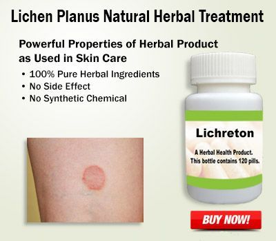 Lichen Planus, Homeopathy Medicine, Natural Antibiotics, Beauty Natural, Skin Disorders, Alternative Treatments, Best Supplements, Herbal Supplements, Homeopathy