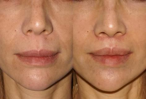 Liplift Surgery Before And After, Short Philtrum, Lip Lift Before And After, Lip Lift Surgery, Beauty Surgery, Kpop Plastic Surgery, Aesthetic Facial, Jaw Reduction Surgery, Nose Surgery Rhinoplasty