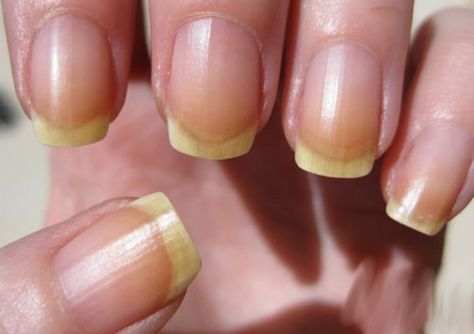 Pitted Nails, Stained Nails, Nail Discoloration, Nail Remedies, Nail Vitamins, Weak Nails, Fungal Nail, Brittle Nails, Nail Growth