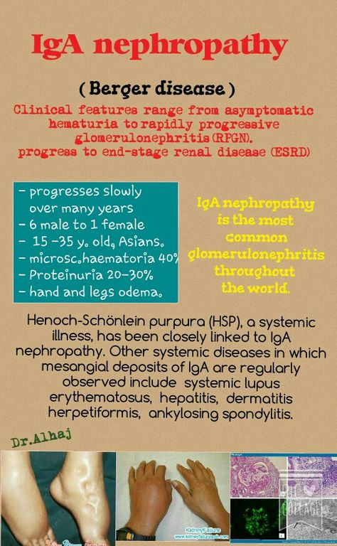IgA nephropathy is the most common glomerulonephritis throughout the world. Iga Nephropathy Diet, Iga Nephropathy, Iga Nephropathy Quotes, Medical Laboratory Science, Kidney Health, Medical Laboratory, Medical Education, Autoimmune Disease, Anatomy And Physiology