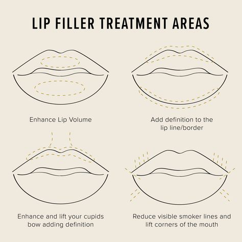 At Home Lip Filler, Lip Filler Captions Instagram, Lip Shapes Filler, Benefits Of Lip Filler, Lip Filler Mapping, Lip Filler Facts, Dermal Fillers Quotes, Lip Filler Healing Stages, Lip Filler Shapes