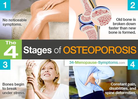 Exercises For Osteoporosis For Women, How To Prevent Osteoporosis, Pilates For Osteoporosis, Osteoporosis Symptoms, Bone Density Test, Osteoporosis Diet, Preventing Osteoporosis, Yoga For Osteoporosis Bones, Bone Healing