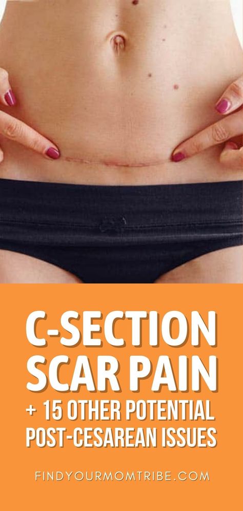 C-section scar pain can be annoying to deal with, but it's not the only aftereffect of a C-section delivery. See the others here. C Section Scar Healing, C Section Healing, Section Scar Tattoo, C Section Scar Tattoo, Mom Pooch, C Section Scar, Post C Section, Postnatal Care, Gallbladder Health