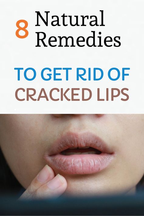 In addition to looking bad, cracked lips turn into a wound and causes pain. It hurts you while eating, drinking, or even trying to talk or laugh. So, which natural methods are used for chapped/cracked lips? Remedies For Chapped Lips, Chapped Lips Remedy, Remedies For Dry Mouth, Home Remedies For Warts, Oily Skin Remedy, Warts Remedy, Dry Cracked Lips, Natural Remedies For Migraines, Sunburn Relief