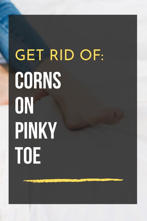 Get Rid Of Corns On Feet Fast, Remove Corns On Feet Remedies, Foot Corn Removal Remedies, How To Get Rid Of Corns On Toes, Corn Removal On Toes, Get Rid Of Corns, Feet Remedies, Corn Removal, Treat Cones