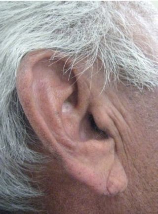 Example of Frank’s Sign Diagonal Earlobe Crease Ear References, Anatomy Practice, University Of Sheffield, Actor James, Botanical Beauty, Anatomy Reference, The Culture, Art References, Sanders