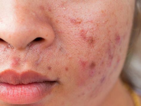 Skin Care Myths, Diy Facial Cleanser, Post Inflammatory Hyperpigmentation, Homemade Facial, Skin Peel, Natural Acne Remedies, Types Of Acne, Body Acne, Facial Products