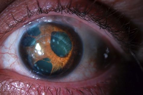 Eye with polycoria (multiple pupils) - Imgur Credit: Biomancer Multiple Pupils, Hair Whorl, Unique Eyes, Eyes Aesthetic, Human Oddities, Beautiful Features, Dark Cottagecore, Face Reference, Unusual Things