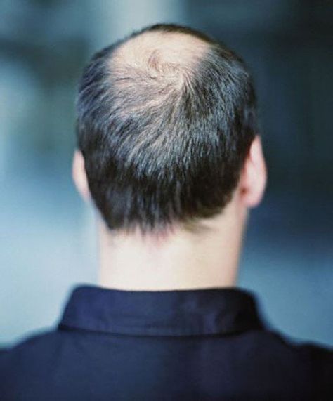 Common reasons for hair loss and how you can prevent hair loss. If you do suffer from hair loss make sure you are getting enough iron in your diet and limiting your stress levels can be helpful too. Growing Thicker Hair, Thick Hair Solutions, Ways To Grow Hair, Baldness Solutions, Grow Thicker Hair, Hair For Men, Thick Natural Hair, Healthy Shiny Hair, Thick Hair Growth