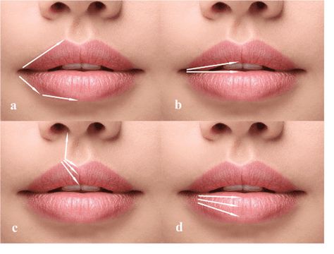 Cadaveric Assessment of Lip Injections: Locating the Serious Threats | Semantic Scholar Filler Techniques, Dermal Fillers Lips, Hyaluronic Acid Fillers, Facial Fillers, Lip Augmentation, Facial Aesthetics, Cosmetic Dermatology, Injectables Fillers, Lip Filler