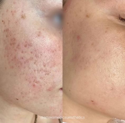 We are thrilled to share the amazing progress we’ve achieved for one of our clients after just 4 sessions of Pixel8-RF Microneedling! Here’s what we’ve accomplished so far:

☑️ Skin tightening
☑️ Wrinkle reduction
☑️ Acne scar improvement
☑️ Skin tone and texture improvement
☑️ Pore reduction

In this specific case, we worked extensively on acne scars, and the results have been incredible — nearly complete scar reduction. Rf Microneedling Before And After, Rf Microneedling, Scar Reduction, Acne Scar, Wrinkle Reduction, Skin Tightening, Skin Tone, The Amazing, Skin Tones