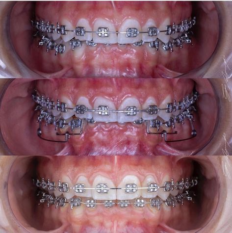 Braces Journey, Shiny Teeth, Teeth Tips, Cute Braces Colors, Braces Tips, Cute Braces, Brace Face, Braces Colors, Orthodontics Braces