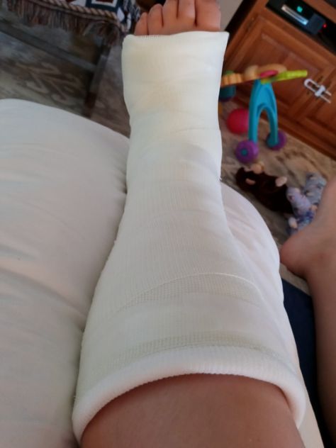 I broke my leg and got surgery today I'm home now and there is no pain. Leg Plaster Snapchat, Broke Leg Snapchat, Eyes Images, Beautiful Eyes Images, Leg Cast, Leg Injury, Scammer Pictures, Document Sign, Snapchat Picture