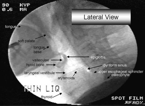 MBS Anatomy (Lateral View) Speech Language Pathology Grad School, Dysphagia Therapy, Speech Therapy Tools, Slp Materials, Teacher Aesthetic, Slp Activities, Slp Resources, Speech Path, Speech Therapy Resources